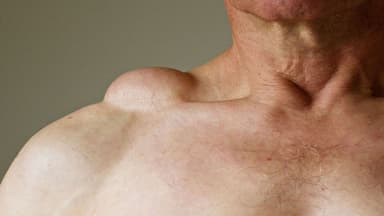 U mỡ là gì? Nguyên nhân, dấu hiệu, các loại thường gặp