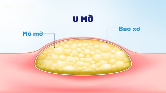 U mỡ ở mông có nguy hiểm không? Điều trị thế nào?