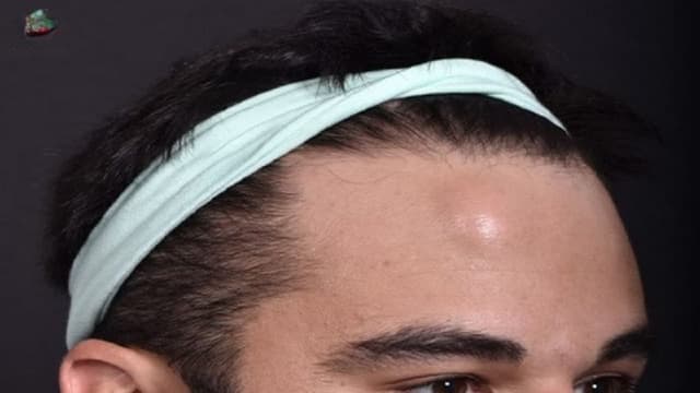 U mỡ ở trán có nguy hiểm không?