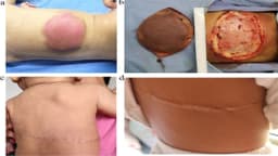 U mỡ ở trẻ em: Nguyên nhân và cách xử lý