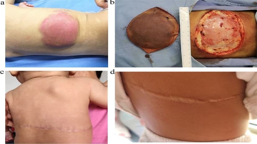 U mỡ ở trẻ em: Nguyên nhân và cách xử lý