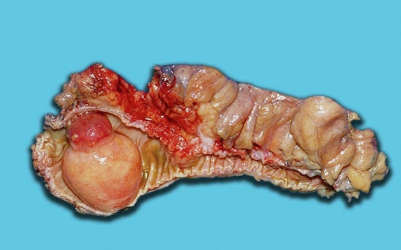 u mỡ đại tràng