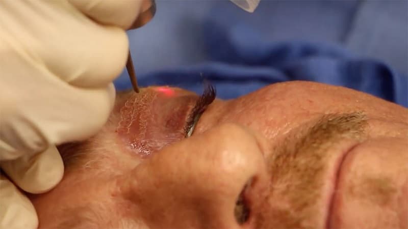 cách trị u mỡ vàng xung quanh mắt