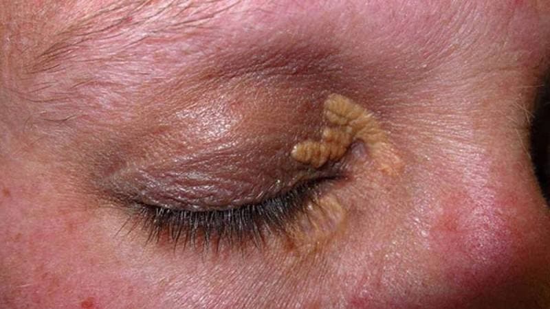 cách trị u mỡ vàng xung quanh mắt