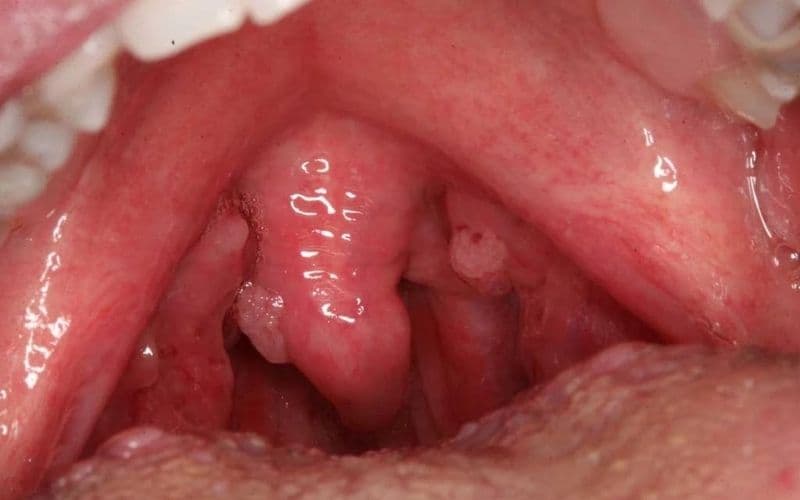 u amidan lành tính