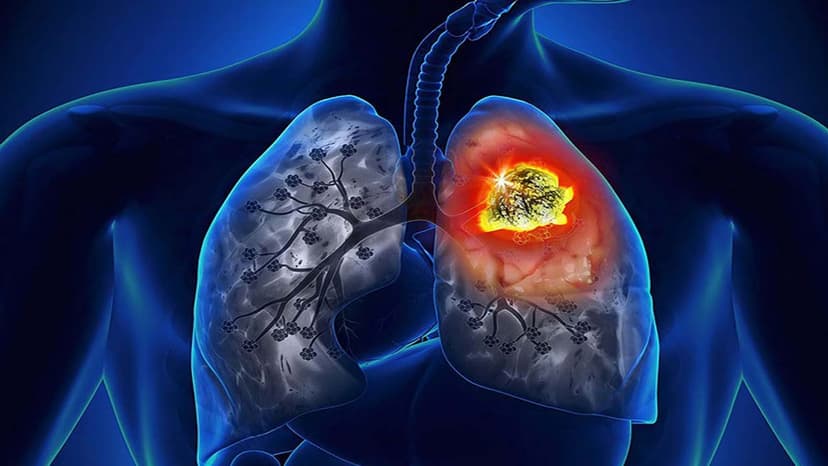 U phổi lành tính có đau không?