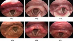 U thanh quản lành tính có cần phẫu thuật?