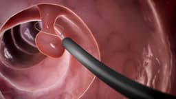 U thực quản lành tính có nguy hiểm không?