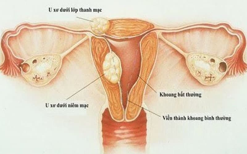 u xơ tử cung có ảnh hưởng đến thai nhi