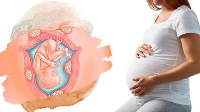 Bị u xơ tử cung có ảnh hưởng đến thai nhi?