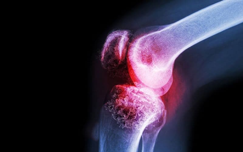 u xương lành tính có đau không