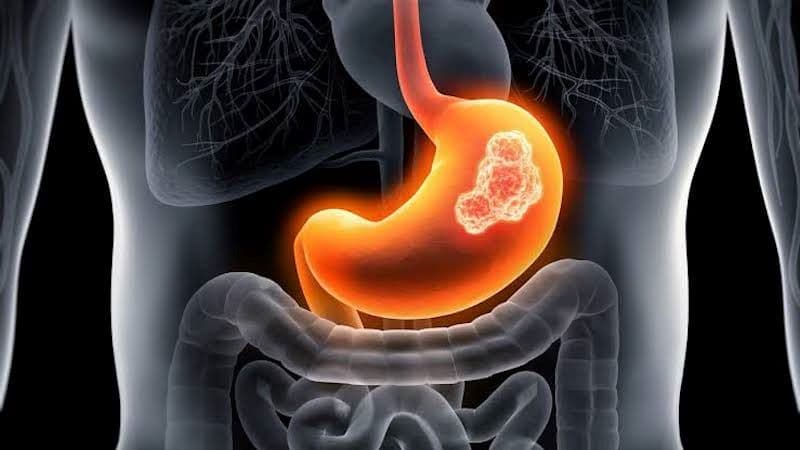 ung thư dạ dày di căn phổi sống được bao lâu