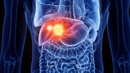 Ung thư gan có gen di truyền không?