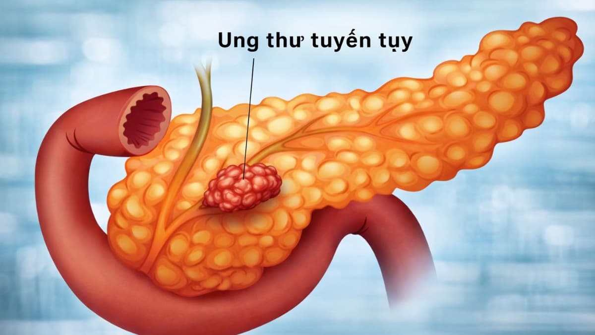 Ung thư tụy: Nguyên nhân gây bệnh và cách phòng ngừa