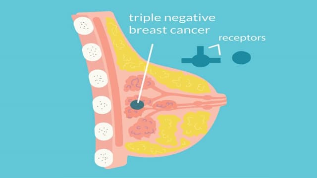 Ung thư vú bộ ba âm tính là gì?
