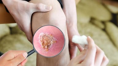 Vết thương bị áp xe là gì? Dấu hiệu, cách điều trị và vệ sinh