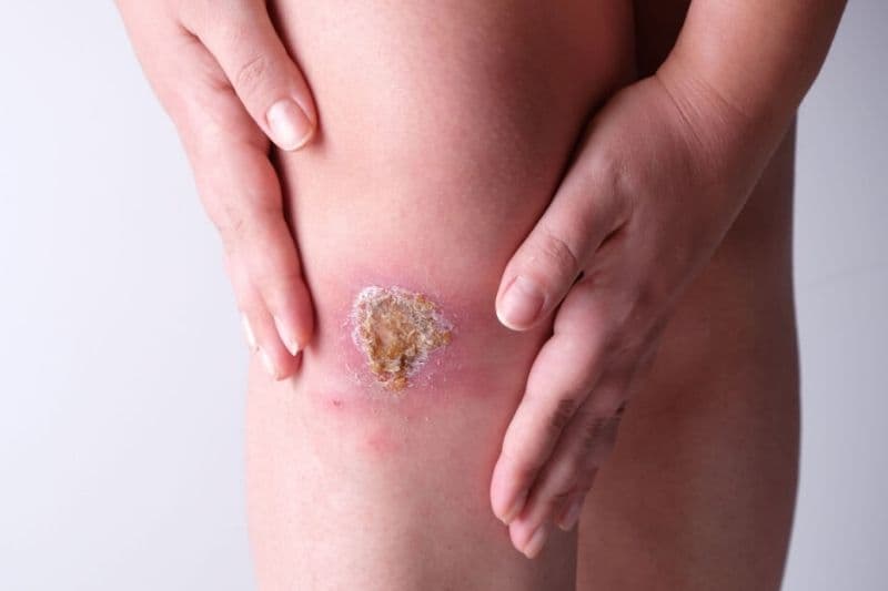 vết thương bị áp xe