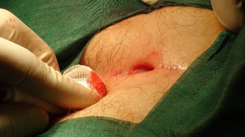 viêm rò xoang lông vùng cùng cụt