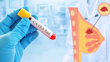 Xét nghiệm CA 15-3 tầm soát ung thư vú có ý nghĩa như thế nào?
