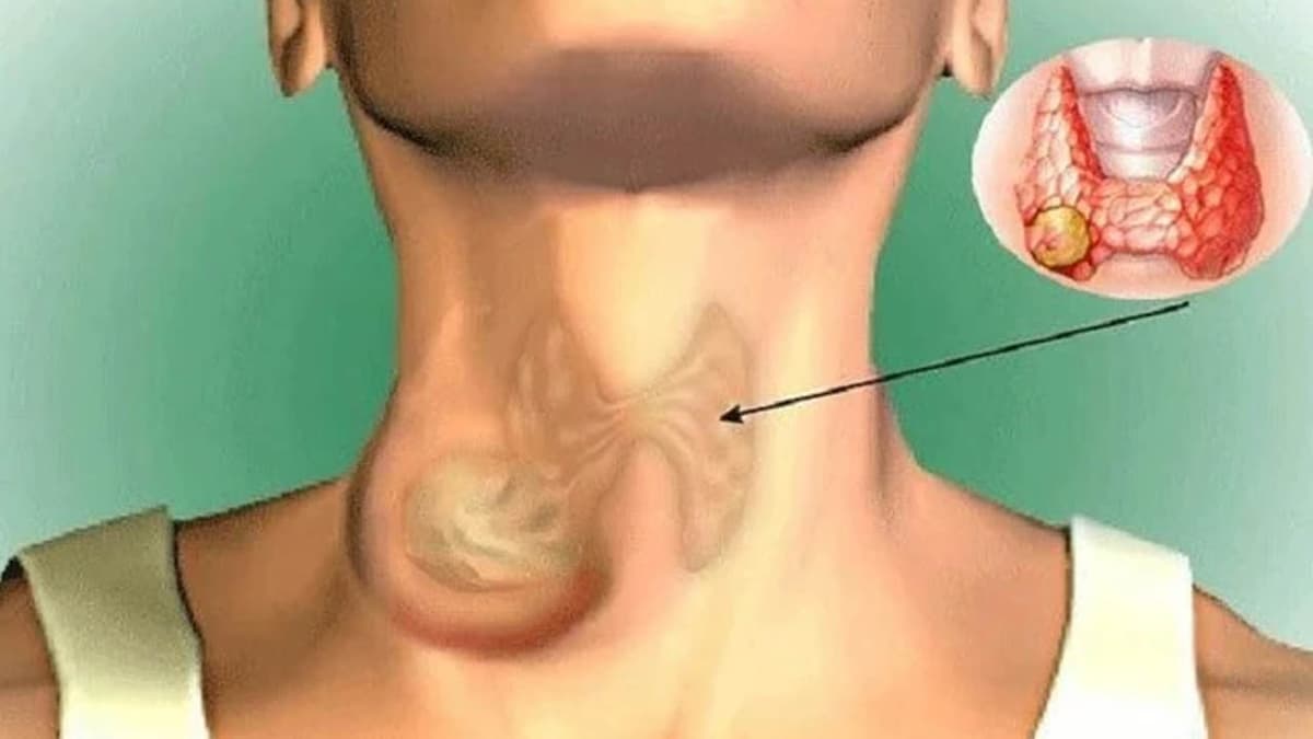 Có thể xét nghiệm gen ung thư đầu cổ không?