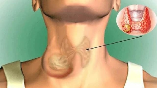 Có thể xét nghiệm gen ung thư đầu cổ không?