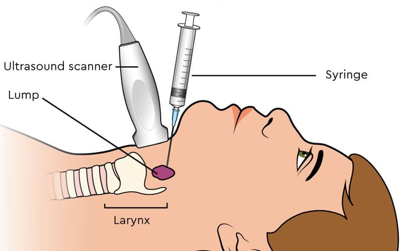 xét nghiệm gen ung thư đầu cổ