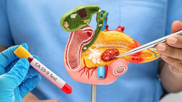 Các xét nghiệm ung thư tụy cần thực hiện