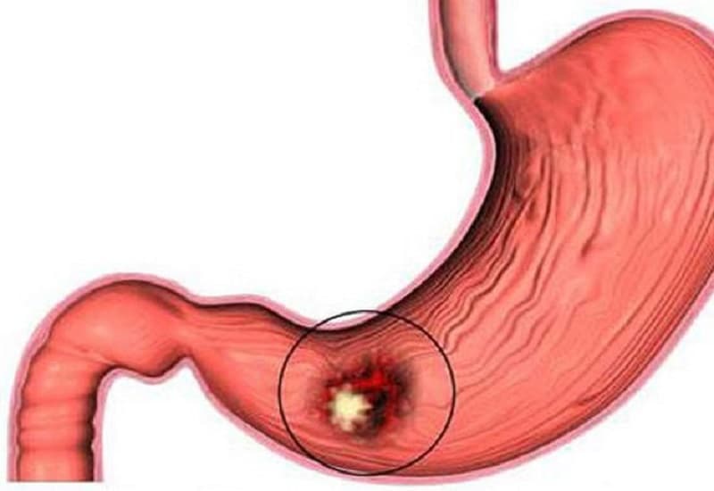viêm loét dạ dày nội soi