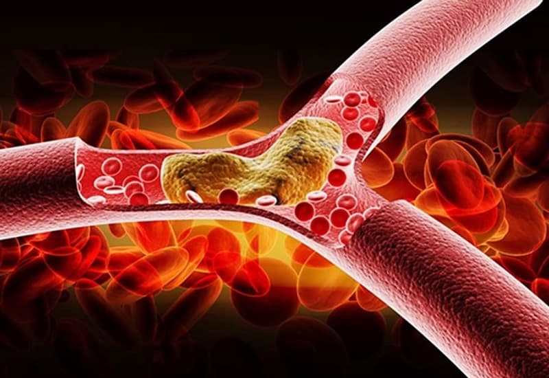 bệnh máu nhiễm mỡ ở người già