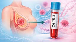 Tìm hiểu về chỉ số CA 15-3 chỉ dấu ung thư vú