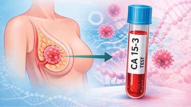 Tìm hiểu về chỉ số CA 15-3 chỉ dấu ung thư vú