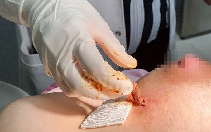 thuốc kháng sinh trị áp xe vú