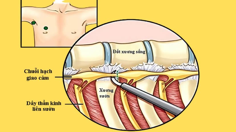 Cắt hạch giao cảm có đau không? Giải đáp chi tiết từ A đến Z