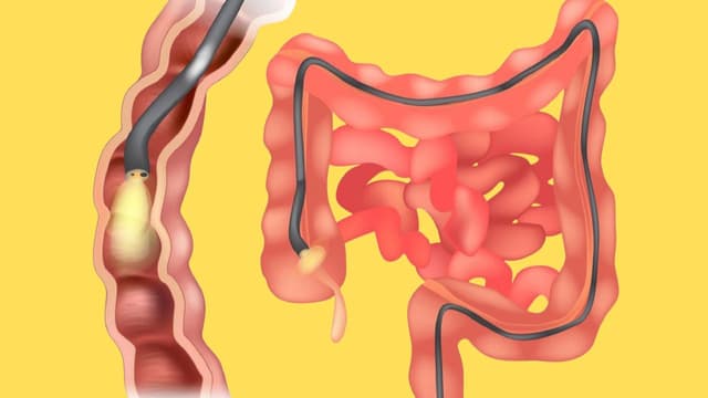 Trước khi nội soi đại tràng nên ăn gì không?