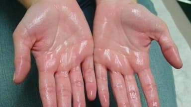 Tăng tiết mồ hôi do cường giao cảm là gì?