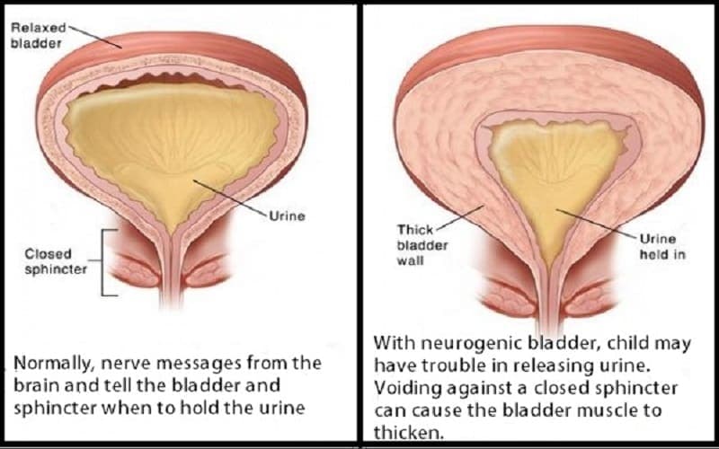 thành bàng quang dày 5mm có sao không