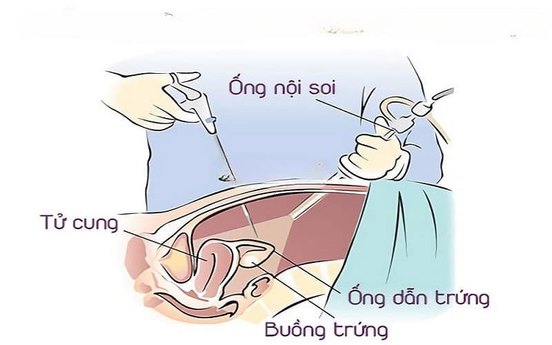 bàng quang giảm hoạt