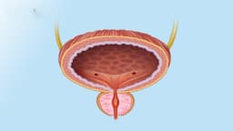 Bàng quang giảm hoạt là gì? Cách điều trị?