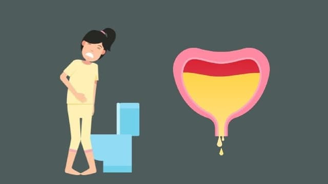 Bị bàng tăng hoạt có nên nhịn tiểu?