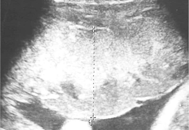 bánh nhau dày có nguy hiểm không