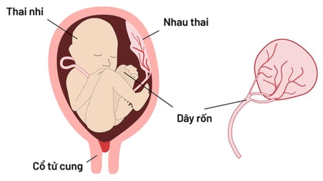 Bánh nhau dày là gì? Bánh nhau dày phải làm sao?