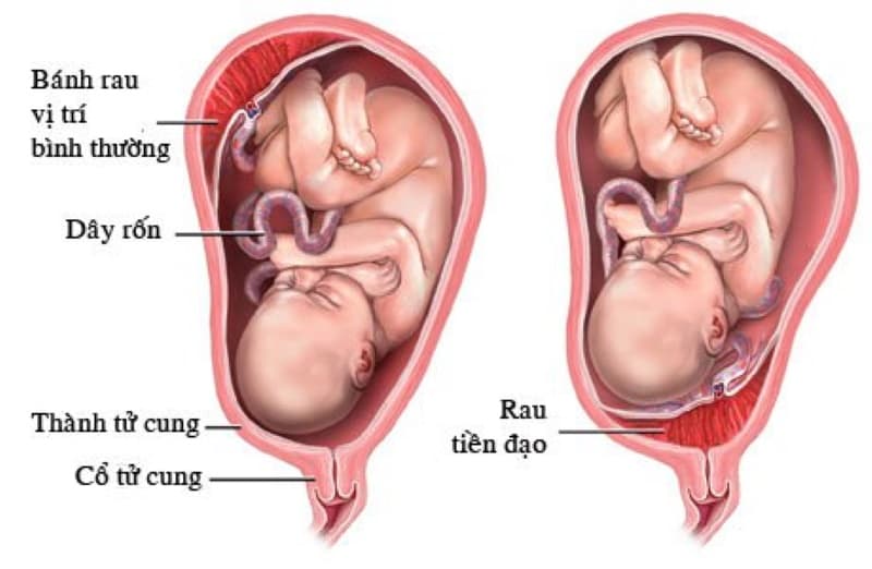 bánh nhau dày là gì