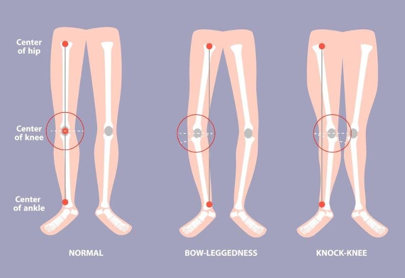 bệnh còi xương do thiếu vitamin d