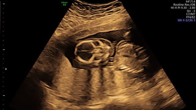 Bị phù nhau thai có nguy hiểm không?