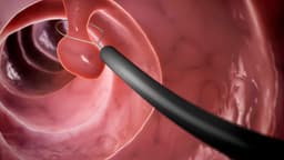 Bị polyp đại tràng có đau bụng không?