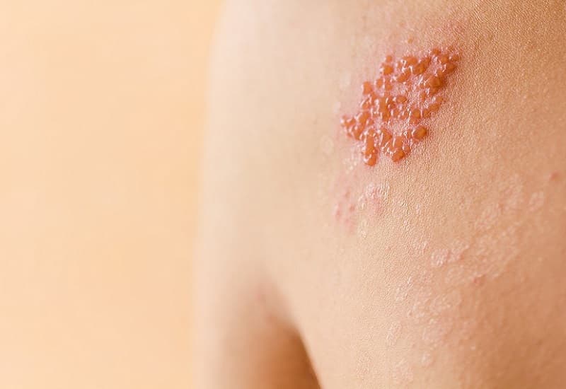 bị zona kiêng ăn thịt gà