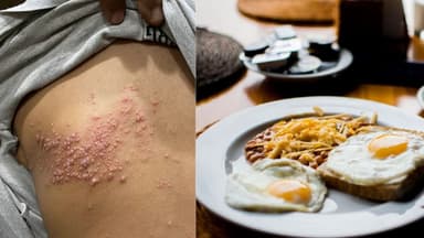 Bị zona có kiêng ăn trứng không?