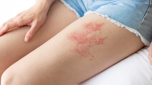 Bị zona có kiêng nước không?