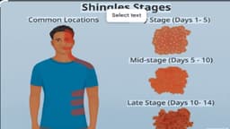 Bị zona có lây không?