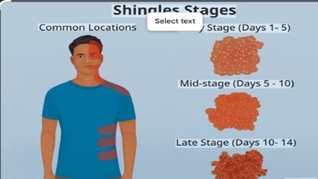 Bị zona có lây không?